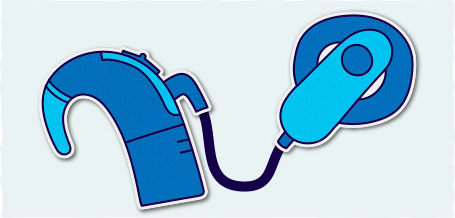 Imatge d'un implant coclear
